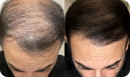 Red Light Therapy Cap for Hair Regrowth