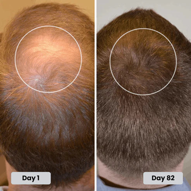 Red Light Therapy Cap for Hair Regrowth